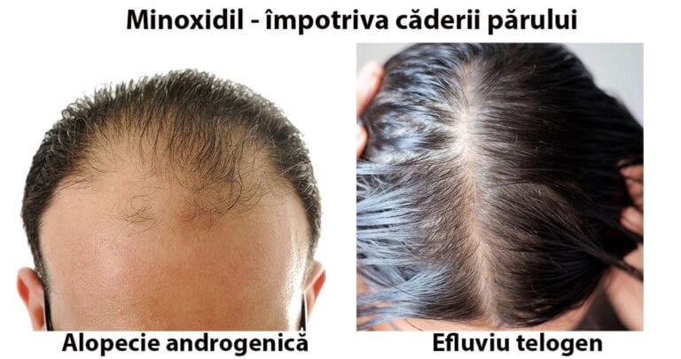 Minoxidil – „stimulator al creșterii părului”